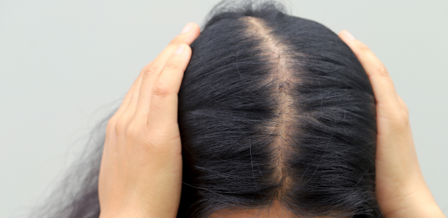 Fase Rambut Rontok Cara Mengatasi Rambut Rontok hingga Kebotakan, Kenali Penyebab dan ...